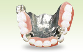 金属床義歯（メタルプレート）